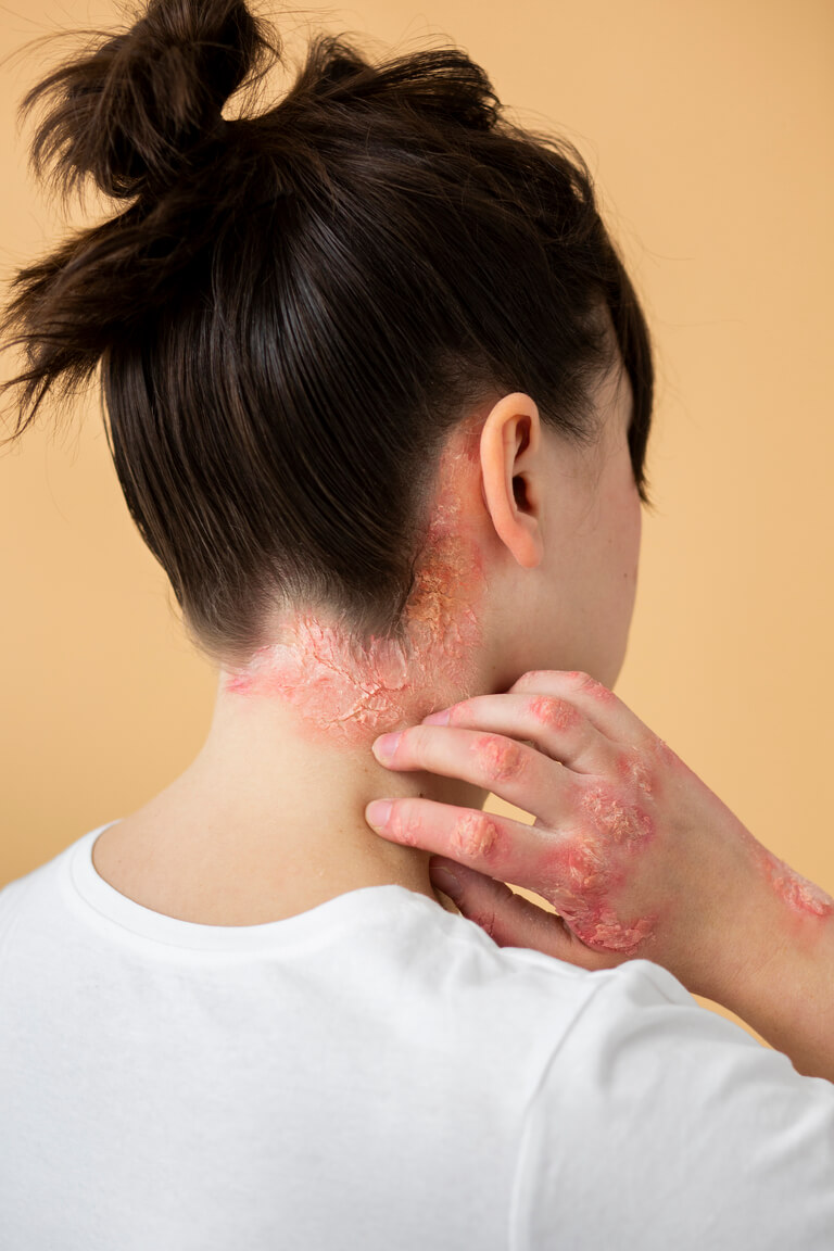 psoriasis sur le cou d'une femme