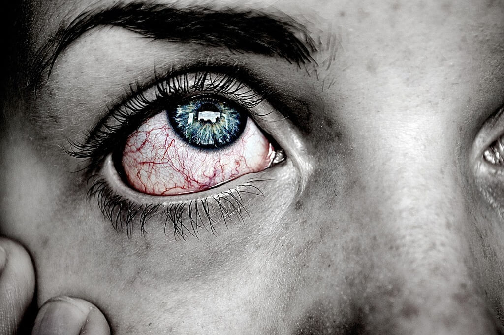 yeux rouges uvéite et spondylarthrite