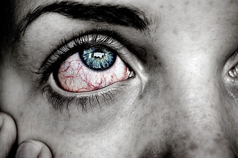 yeux rouges uvéite et spondylarthrite