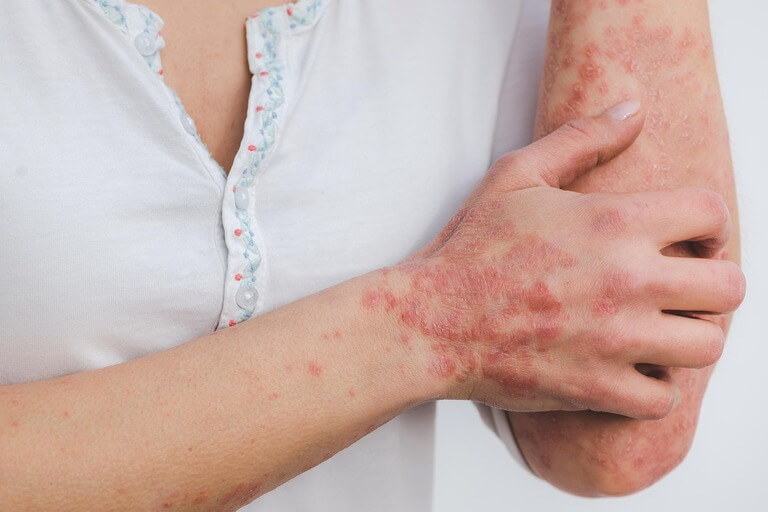 Femme avec du psoriasis sur le coude et les mains